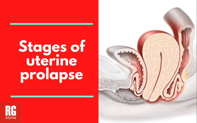 Stages of uterine prolapse